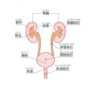 症状 結石